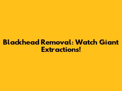Blackhead Removal: Watch Giant Extractions!
